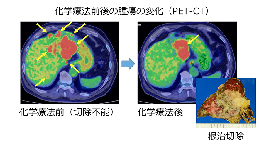 図1　化学療法後に根治切除を行った症例（→腫瘍）